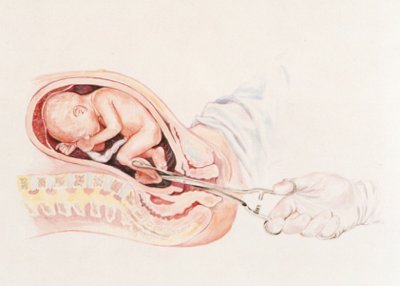 aborto-en-el-embarazo aborto-en-el-embarazo